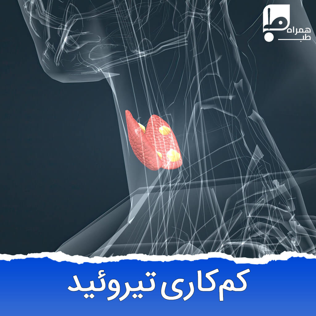 کم کاری تیروئید