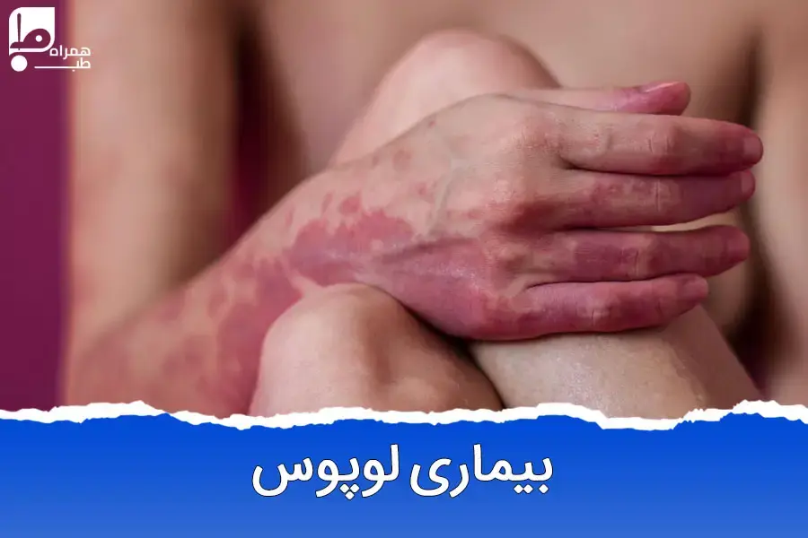 از ریزش مو تا لاغری؛ تاثیرات لوپوس بر بدن و راهکارهای درمانی